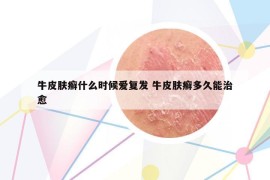 牛皮肤癣什么时候爱复发 牛皮肤癣多久能治愈