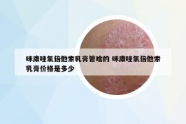 咪康唑氯倍他索乳膏管啥的 咪康唑氯倍他索乳膏价格是多少