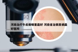 河南治疗牛皮癣哪里最好 河南省治银屑病最好医院