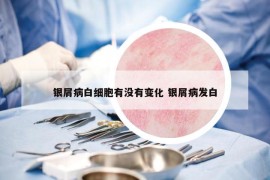 银屑病白细胞有没有变化 银屑病发白