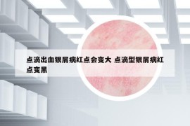 点滴出血银屑病红点会变大 点滴型银屑病红点变黑