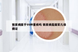 银屑病属于99种重疾吗 银屑病是国家几级病证