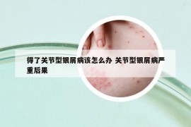 得了关节型银屑病该怎么办 关节型银屑病严重后果