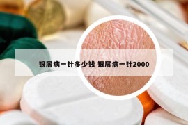 银屑病一针多少钱 银屑病一针2000