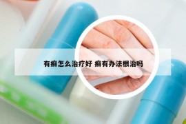 有癣怎么治疗好 癣有办法根治吗