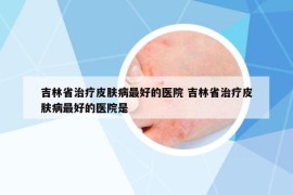 吉林省治疗皮肤病最好的医院 吉林省治疗皮肤病最好的医院是