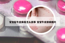 宝宝起牛皮癣是怎么回事 宝宝牛皮肤癣图片