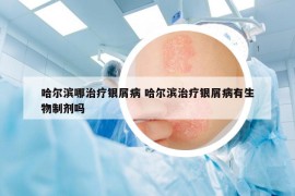 哈尔滨哪治疗银屑病 哈尔滨治疗银屑病有生物制剂吗