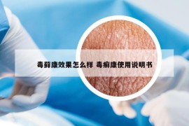 毒藓康效果怎么样 毒癣康使用说明书