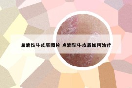 点滴性牛皮屑图片 点滴型牛皮屑如何治疗