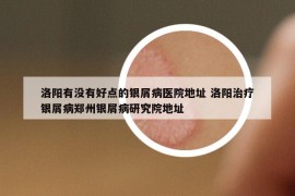 洛阳有没有好点的银屑病医院地址 洛阳治疗银屑病郑州银屑病研究院地址