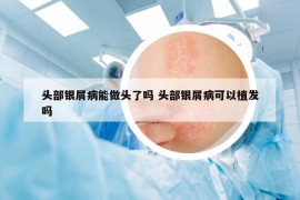 头部银屑病能做头了吗 头部银屑病可以植发吗