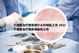 干细胞治疗银屑病什么时候能上市 2021干细胞治疗银屑病最新公布