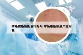 掌跖脓疱病能治疗好吗 掌跖脓疱病最严重后果