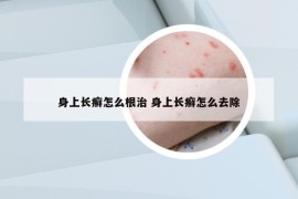 身上长癣怎么根治 身上长癣怎么去除