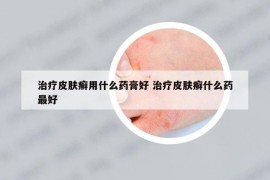 治疗皮肤癣用什么药膏好 治疗皮肤癣什么药最好