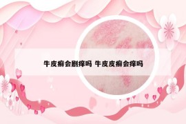 牛皮癣会剧痒吗 牛皮皮癣会痒吗