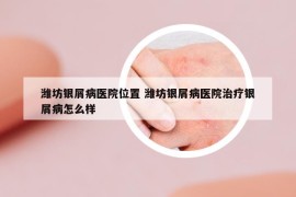 潍坊银屑病医院位置 潍坊银屑病医院治疗银屑病怎么样