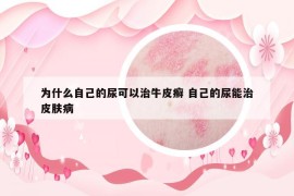 为什么自己的尿可以治牛皮癣 自己的尿能治皮肤病