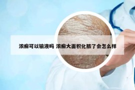 浓癣可以输液吗 浓癣大面积化脓了会怎么样