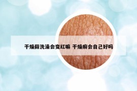 干燥藓洗澡会变红嘛 干燥癣会自己好吗