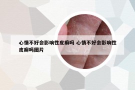 心情不好会影响性皮癣吗 心情不好会影响性皮癣吗图片