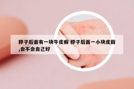 脖子后面有一块牛皮癣 脖子后面一小块皮藓,会不会自己好