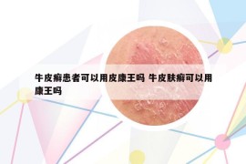 牛皮癣患者可以用皮康王吗 牛皮肤癣可以用康王吗