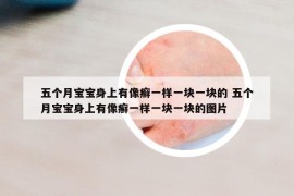 五个月宝宝身上有像癣一样一块一块的 五个月宝宝身上有像癣一样一块一块的图片