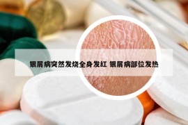 银屑病突然发烧全身发红 银屑病部位发热