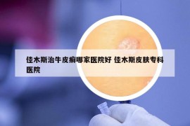 佳木斯治牛皮癣哪家医院好 佳木斯皮肤专科医院