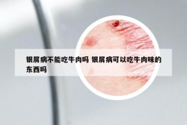 银屑病不能吃牛肉吗 银屑病可以吃牛肉味的东西吗