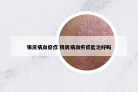 银屑病血瘀症 银屑病血瘀症能治好吗