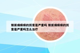 银屑病痒痒的厉害是严重吗 银屑病痒痒的厉害是严重吗怎么治疗