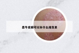 患牛皮癣可以补什么维生素