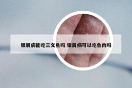 银屑病能吃三文鱼吗 银屑病可以吃鱼肉吗