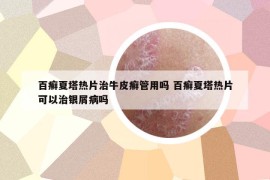 百癣夏塔热片治牛皮癣管用吗 百癣夏塔热片可以治银屑病吗