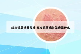 红皮银屑病并发症 红皮银屑病并发症是什么