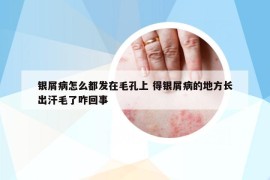 银屑病怎么都发在毛孔上 得银屑病的地方长出汗毛了咋回事