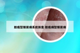 脓疱型银屑病系统损害 脓疱病型银屑病