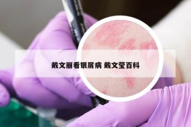 戴文丽看银屑病 戴文莹百科