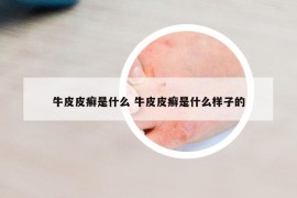 牛皮皮癣是什么 牛皮皮癣是什么样子的