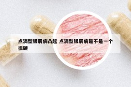 点滴型银屑病凸起 点滴型银屑病是不是一个很硬