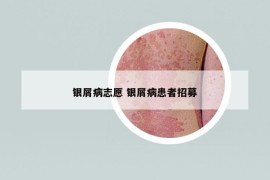 银屑病志愿 银屑病患者招募