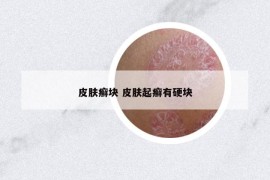 皮肤癣块 皮肤起癣有硬块