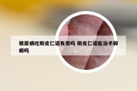 银屑病吃斯皮仁诺有用吗 斯皮仁诺能治手脚癣吗