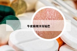 牛皮癣用冷冻贴巴