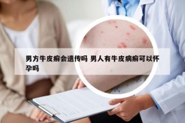 男方牛皮癣会遗传吗 男人有牛皮病癣可以怀孕吗