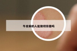 牛皮癣的人能做切你眉吗