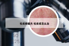 松皮癣偏方 松皮症怎么治